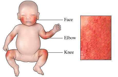Márketing del miedo: En España hay más niños que sufren Dermatitis atópica que niños 1 Márketing del miedo: En España hay más niños que sufren Dermatitis atópica que niños