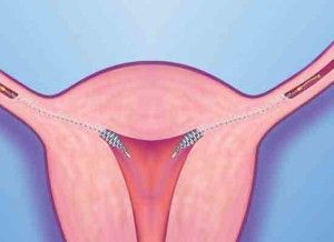 Más problemas de los informados en usuarias del anticonceptivo Essure 3 Essure problems níquel alergia