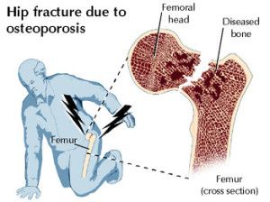 Una jueza cree que ocultar información sobre daños de un fármaco no es delito 3 fractura femur osteoporosis fosamax