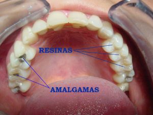 Negacionismo contra las pruebas de que las amalgamas dentales de mercurio son tóxicas 2 amalgamas