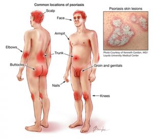 psoriasis otezla