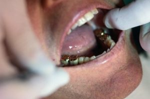 La Unión Europea está prohibiendo los empastes dentales de mercurio 2 mercurio-amalgamas-rivasi