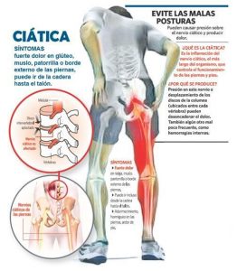 Ciática