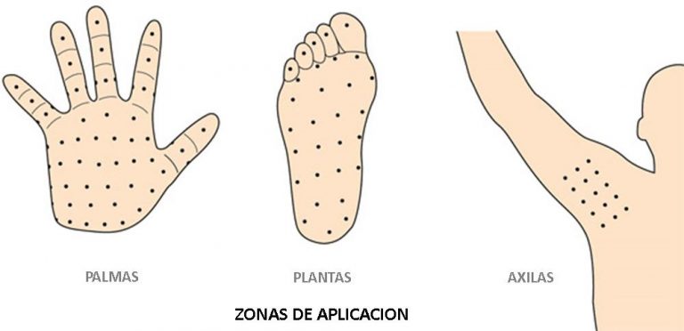 «Venden» la sudoración excesiva como una enfermedad para abrirle mercado al Botox
