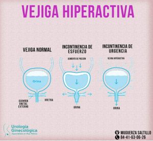 Vejiga hiperactiva