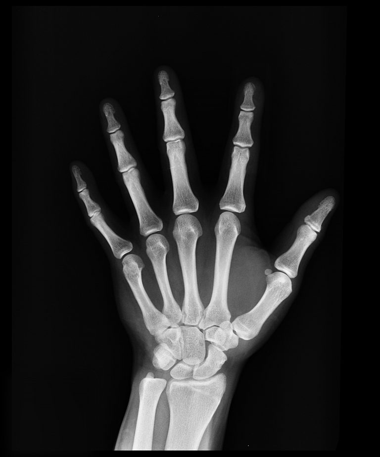 Alternativas naturales a Prolia, el peligroso fármaco para la osteoporosis 4 Alternativas naturales a Prolia, el peligroso fármaco para la osteoporosis
